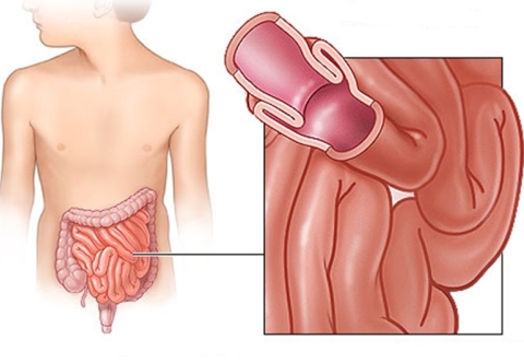 Tổng quan bệnh lồng ruột 